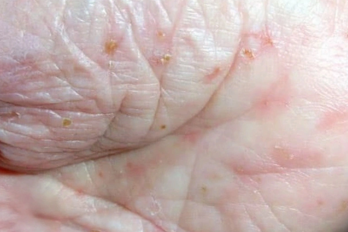 استفاده از نمک برای درمان گال